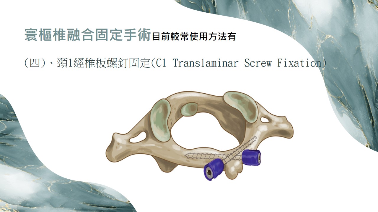 寰樞關節手術示意圖 04